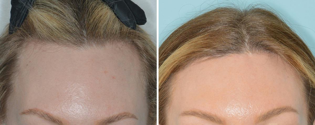 Hair Transplant Before & After Gallery - Patient 234223 - Image 1