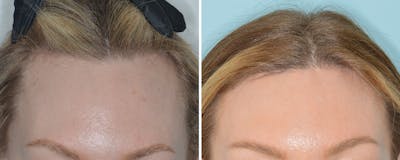 Hair Transplant Before & After Gallery - Patient 234223 - Image 1