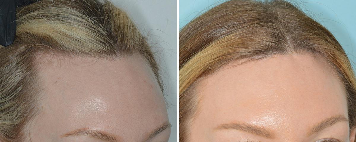 Hair Transplant Before & After Gallery - Patient 234223 - Image 2