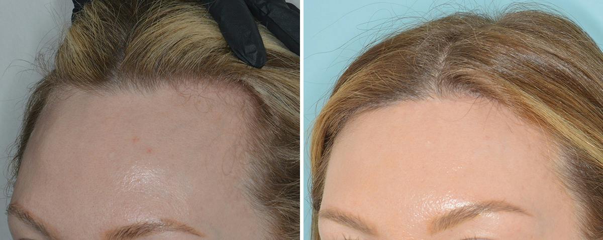 Hair Transplant Before & After Gallery - Patient 234223 - Image 3
