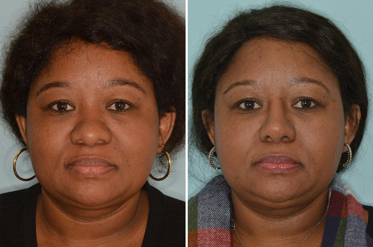 Ethnic Rhinoplasty Before & After Gallery - Patient 722749 - Image 1