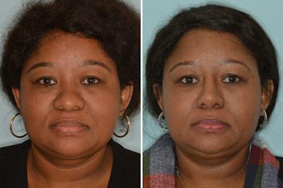 Ethnic Rhinoplasty Before & After Gallery - Patient 722749 - Image 1