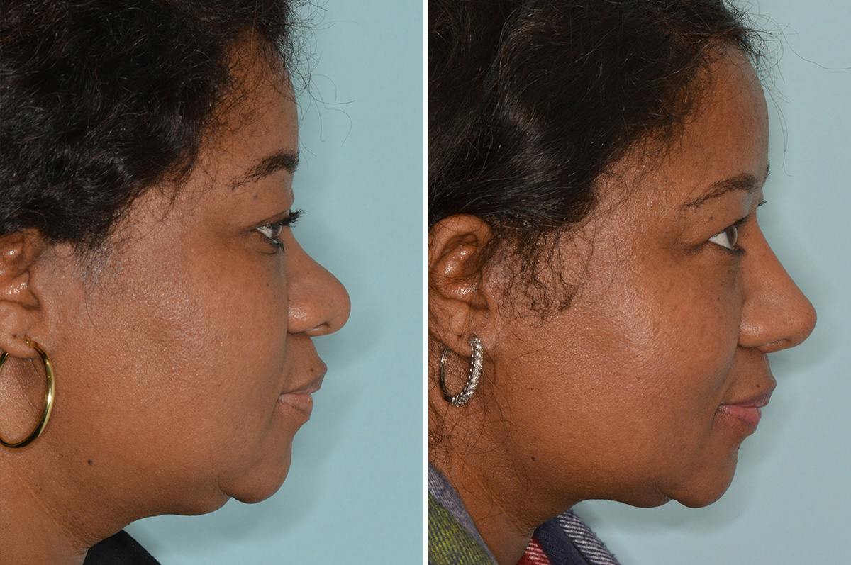 Ethnic Rhinoplasty Before & After Gallery - Patient 722749 - Image 2