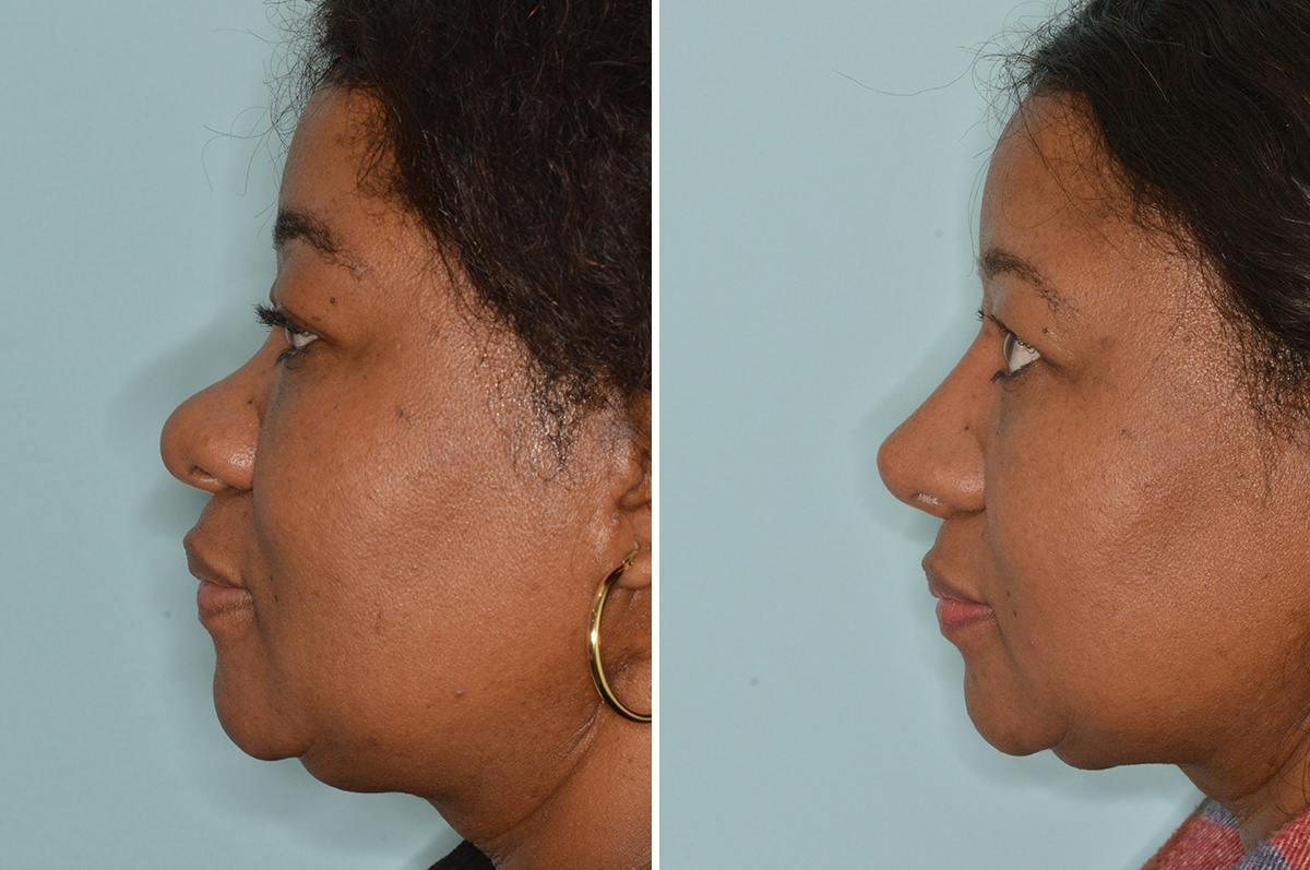 Ethnic Rhinoplasty Before & After Gallery - Patient 722749 - Image 3