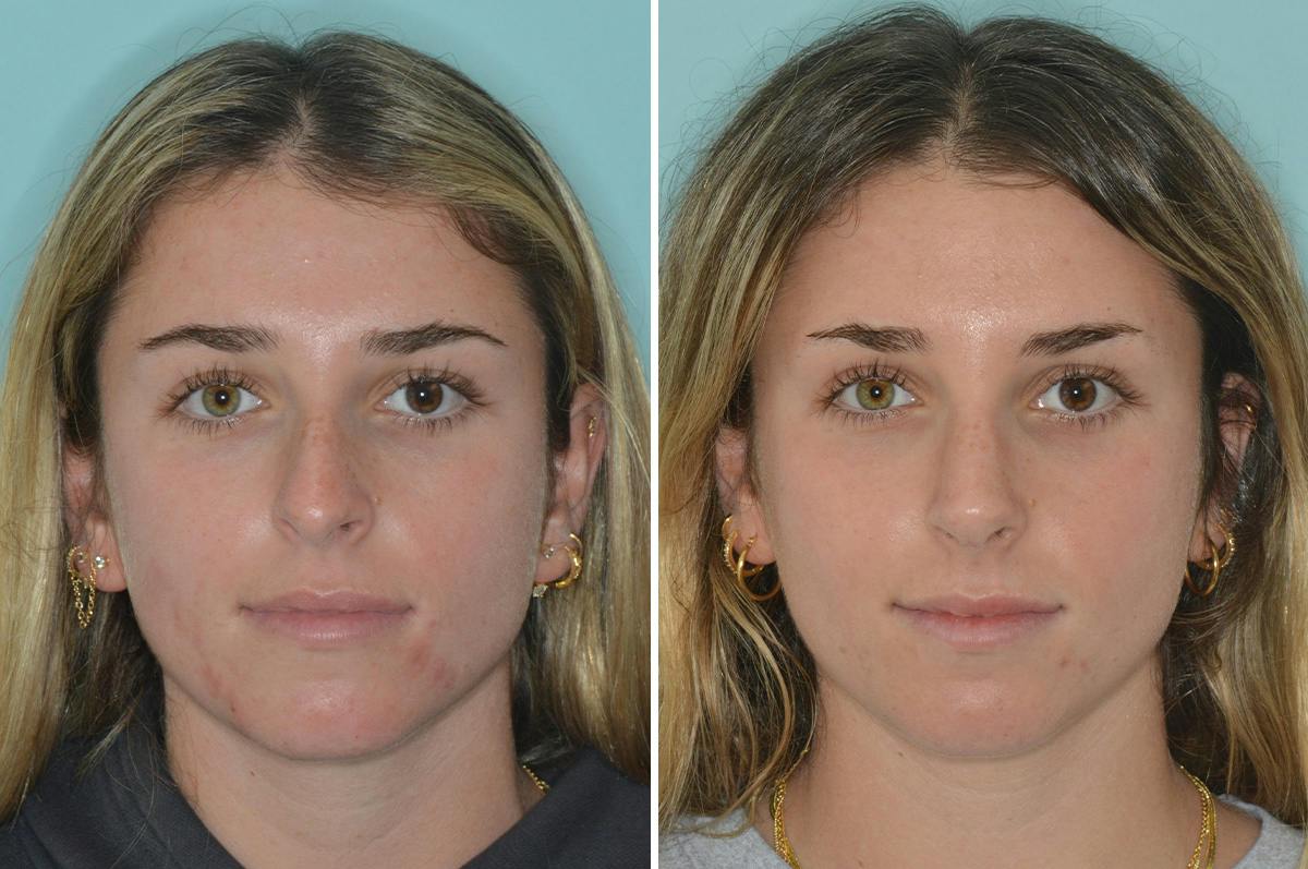 Rhinoplasty Before & After Gallery - Patient 377721 - Image 3