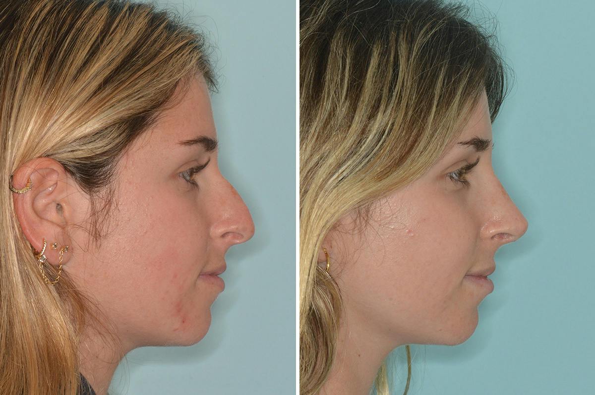 Rhinoplasty Before & After Gallery - Patient 377721 - Image 1