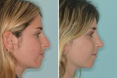 Rhinoplasty Before & After Gallery - Patient 377721 - Image 1