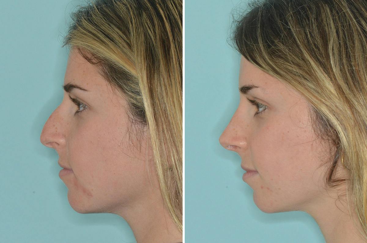 Rhinoplasty Before & After Gallery - Patient 377721 - Image 2