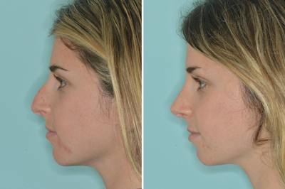 Rhinoplasty Before & After Gallery - Patient 377721 - Image 2