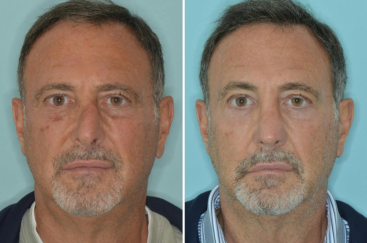 Rhinoplasty Before & After Gallery - Patient 422581 - Image 1