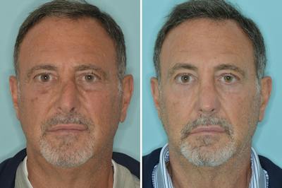 Rhinoplasty Before & After Gallery - Patient 422581 - Image 1