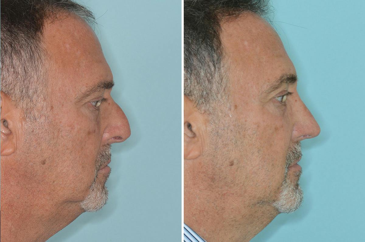 Rhinoplasty Before & After Gallery - Patient 422581 - Image 2