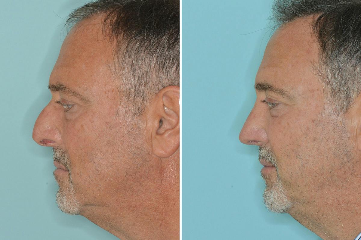 Rhinoplasty Before & After Gallery - Patient 422581 - Image 3