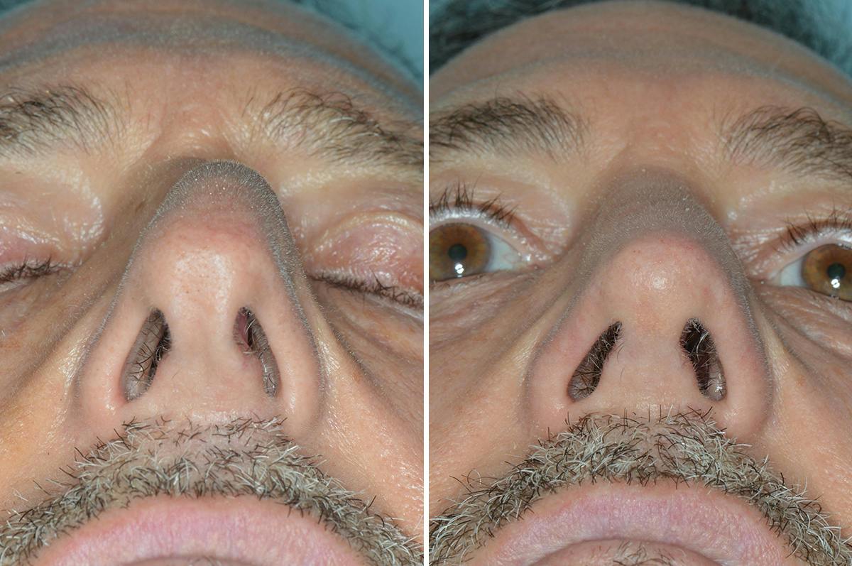 Rhinoplasty Before & After Gallery - Patient 422581 - Image 4