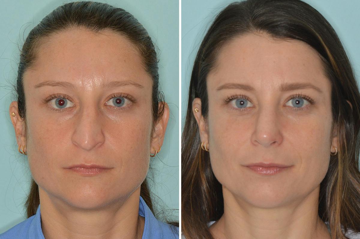 Rhinoplasty Before & After Gallery - Patient 164388 - Image 3