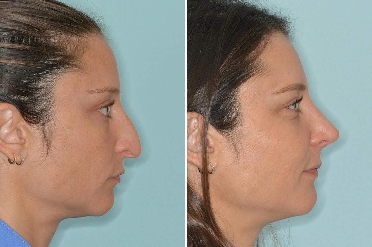 Rhinoplasty Before & After Gallery - Patient 164388 - Image 1