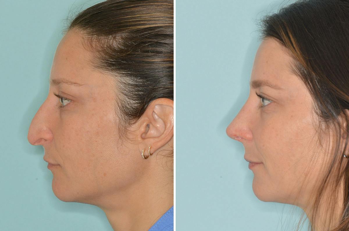 Rhinoplasty Before & After Gallery - Patient 164388 - Image 2