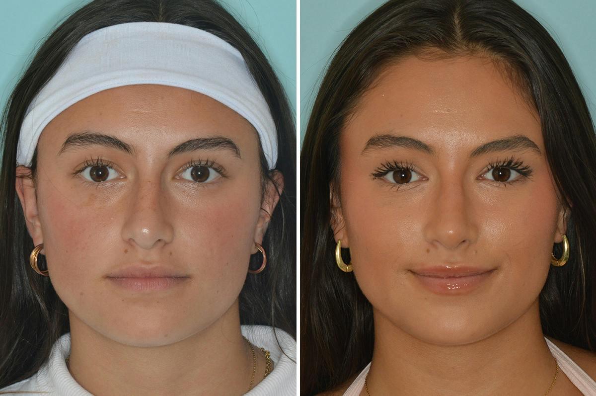 Rhinoplasty Before & After Gallery - Patient 377298 - Image 3