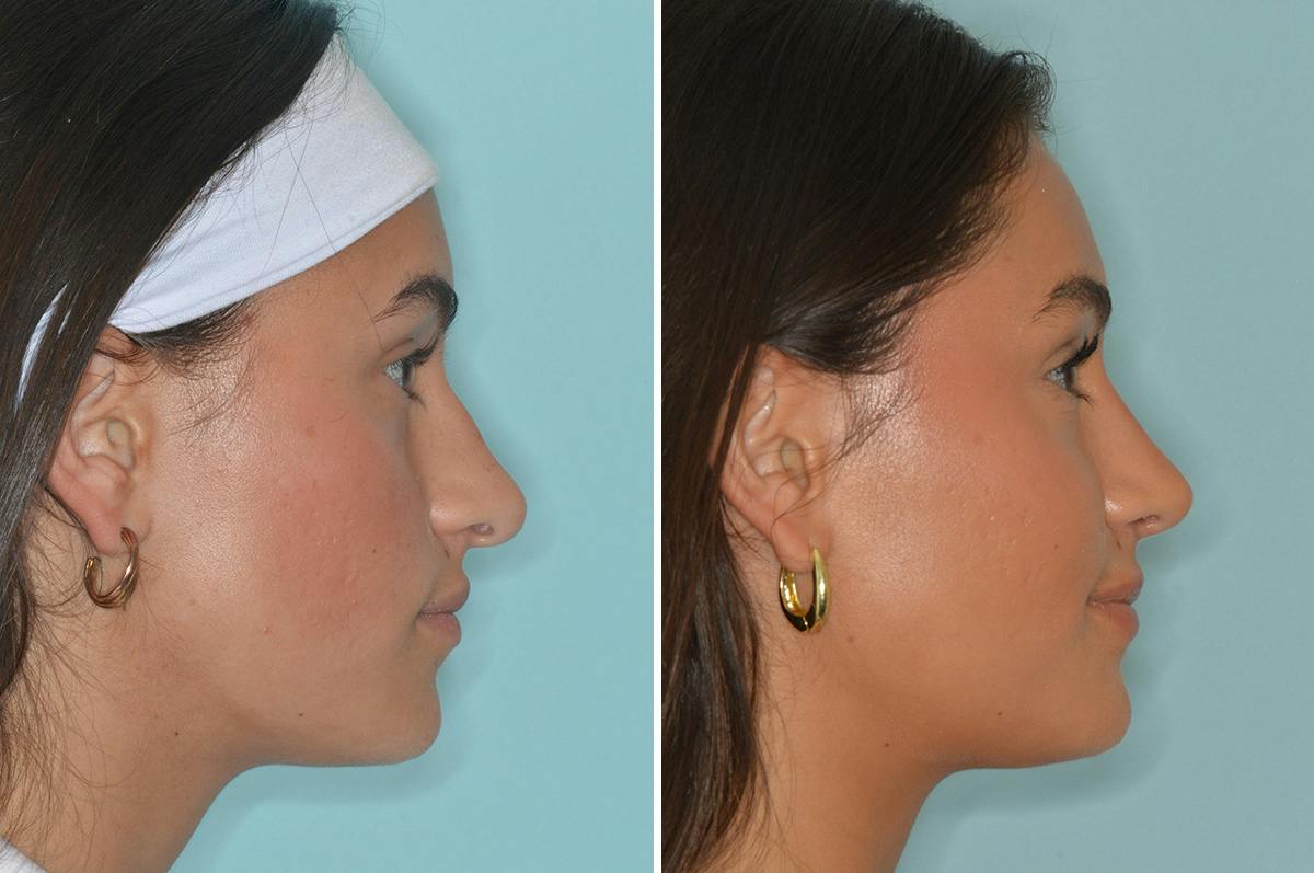 Rhinoplasty Before & After Gallery - Patient 377298 - Image 1