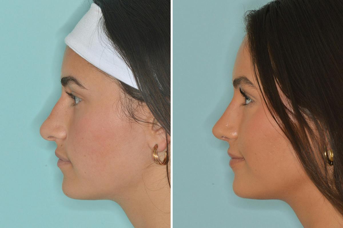 Rhinoplasty Before & After Gallery - Patient 377298 - Image 2
