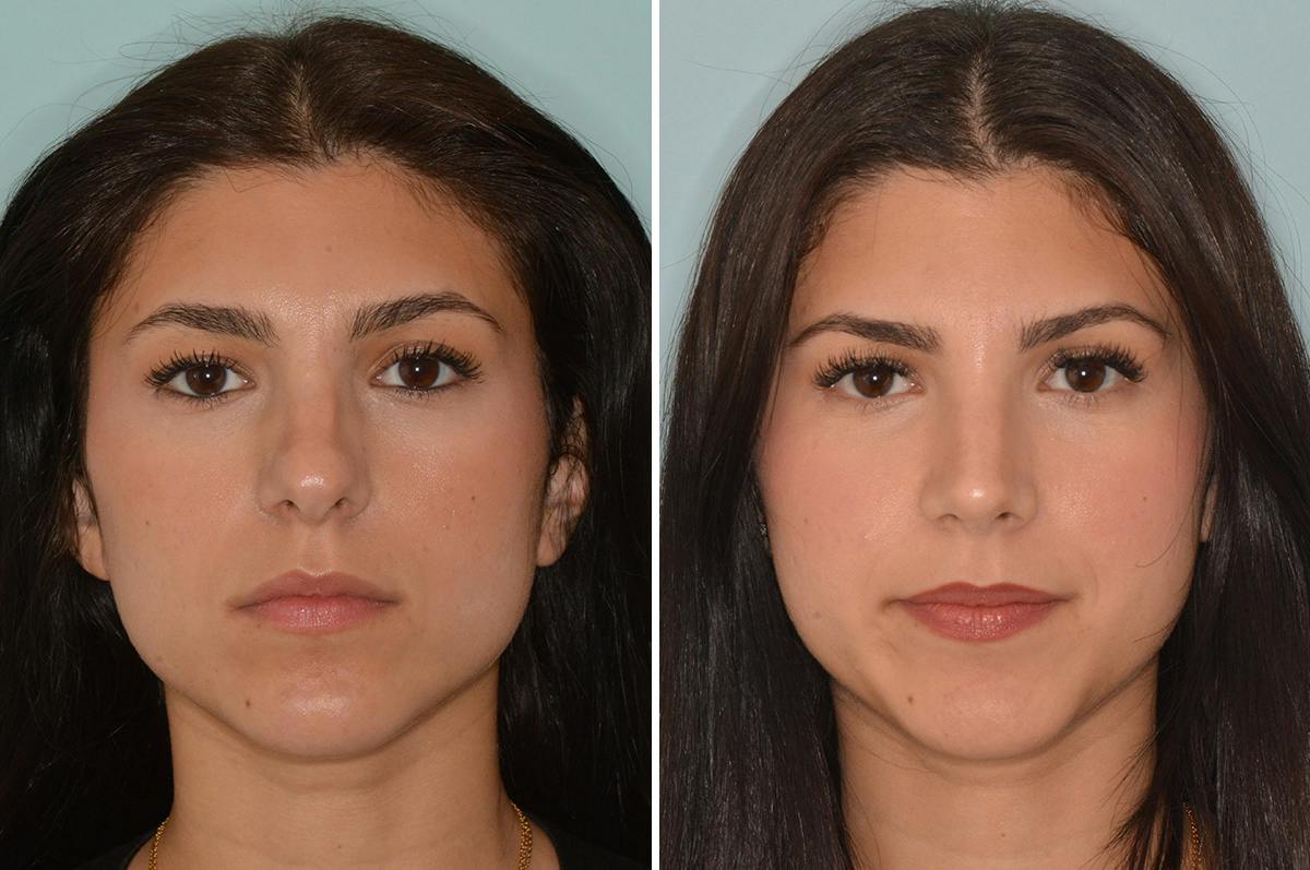 Rhinoplasty Before & After Gallery - Patient 537794 - Image 3