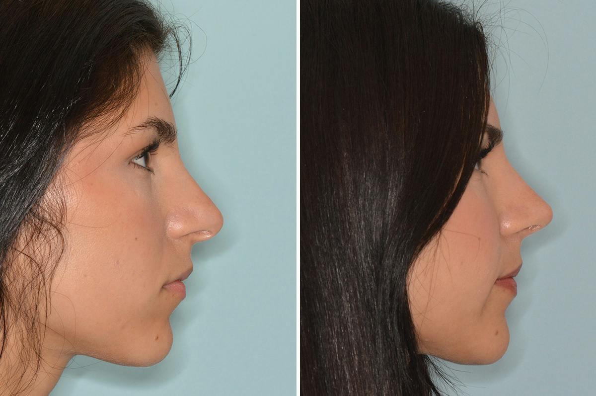 Rhinoplasty Before & After Gallery - Patient 537794 - Image 1