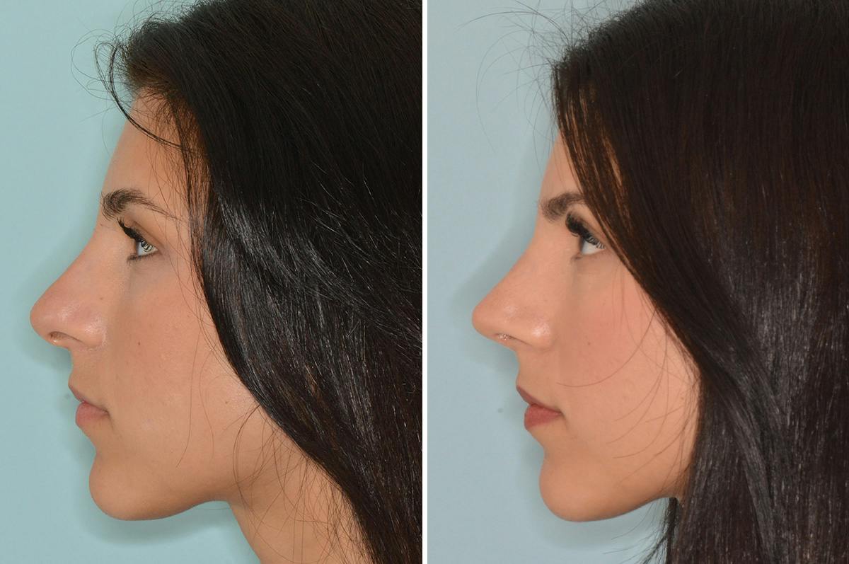 Rhinoplasty Before & After Gallery - Patient 537794 - Image 2