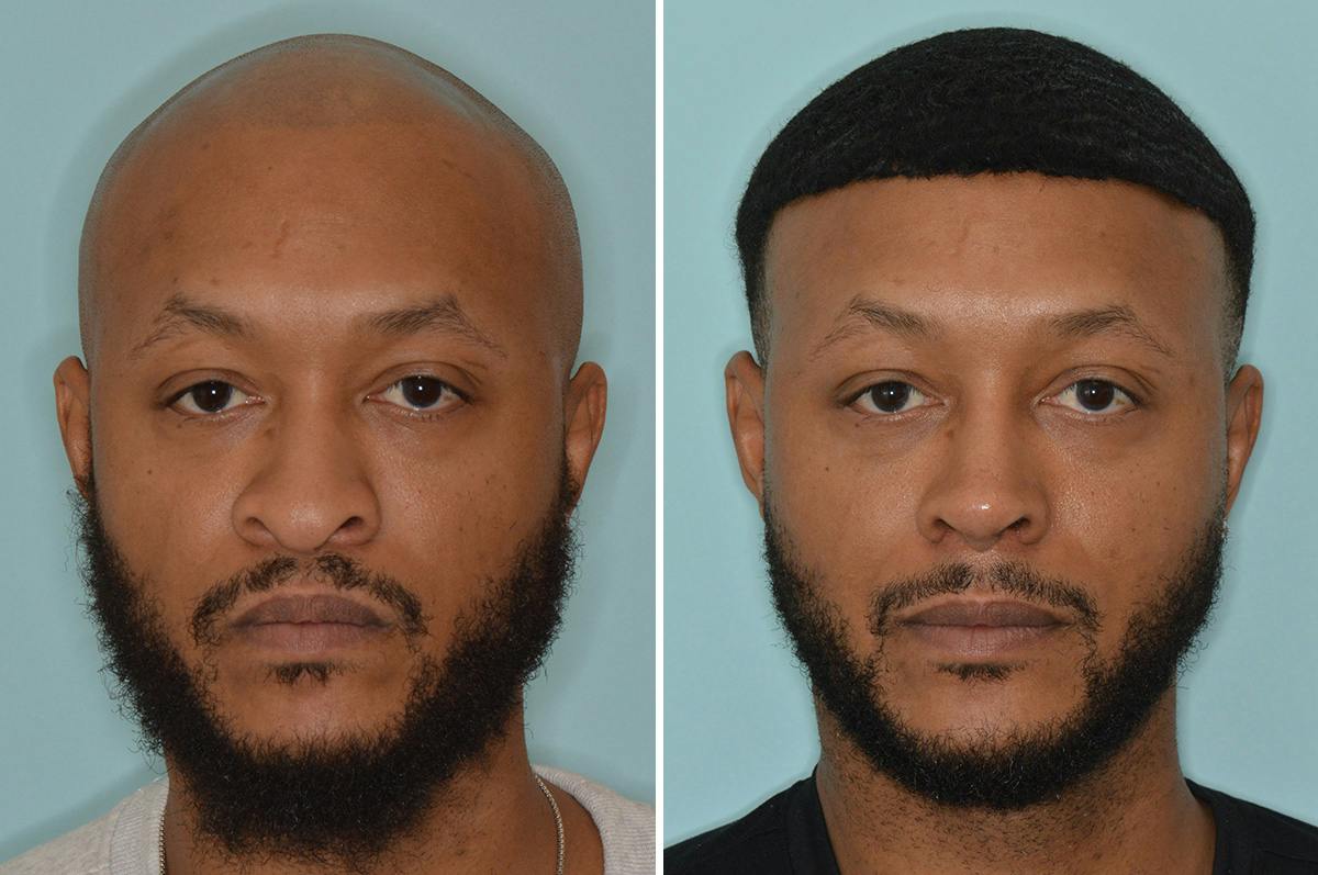 Ethnic Rhinoplasty Before & After Gallery - Patient 246842 - Image 3