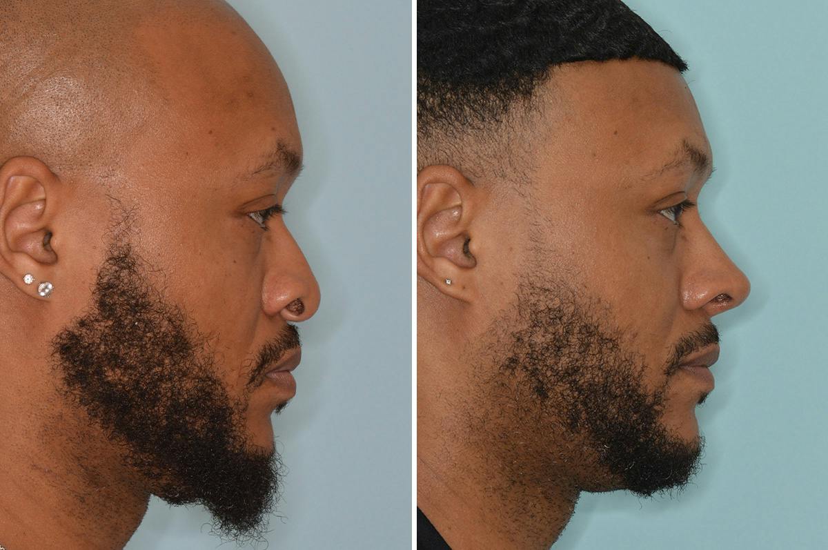 Ethnic Rhinoplasty Before & After Gallery - Patient 246842 - Image 1