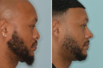 Ethnic Rhinoplasty Before & After Gallery - Patient 246842 - Image 1