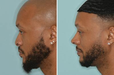 Ethnic Rhinoplasty Before & After Gallery - Patient 246842 - Image 2