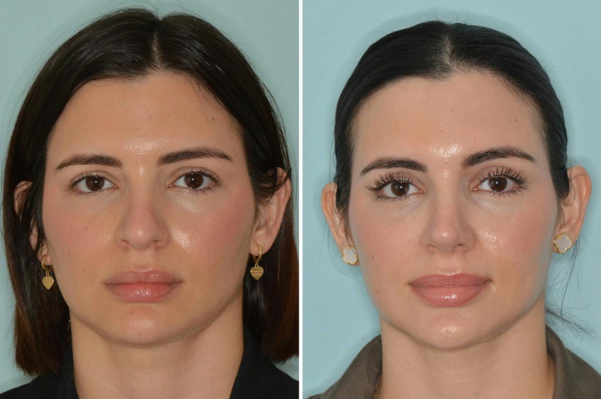 Rhinoplasty Before & After Gallery - Patient 124095 - Image 3