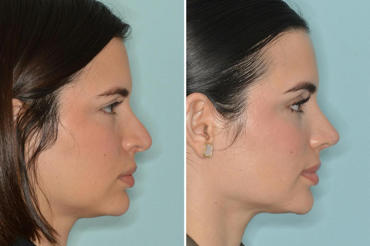 Rhinoplasty Before & After Gallery - Patient 124095 - Image 1