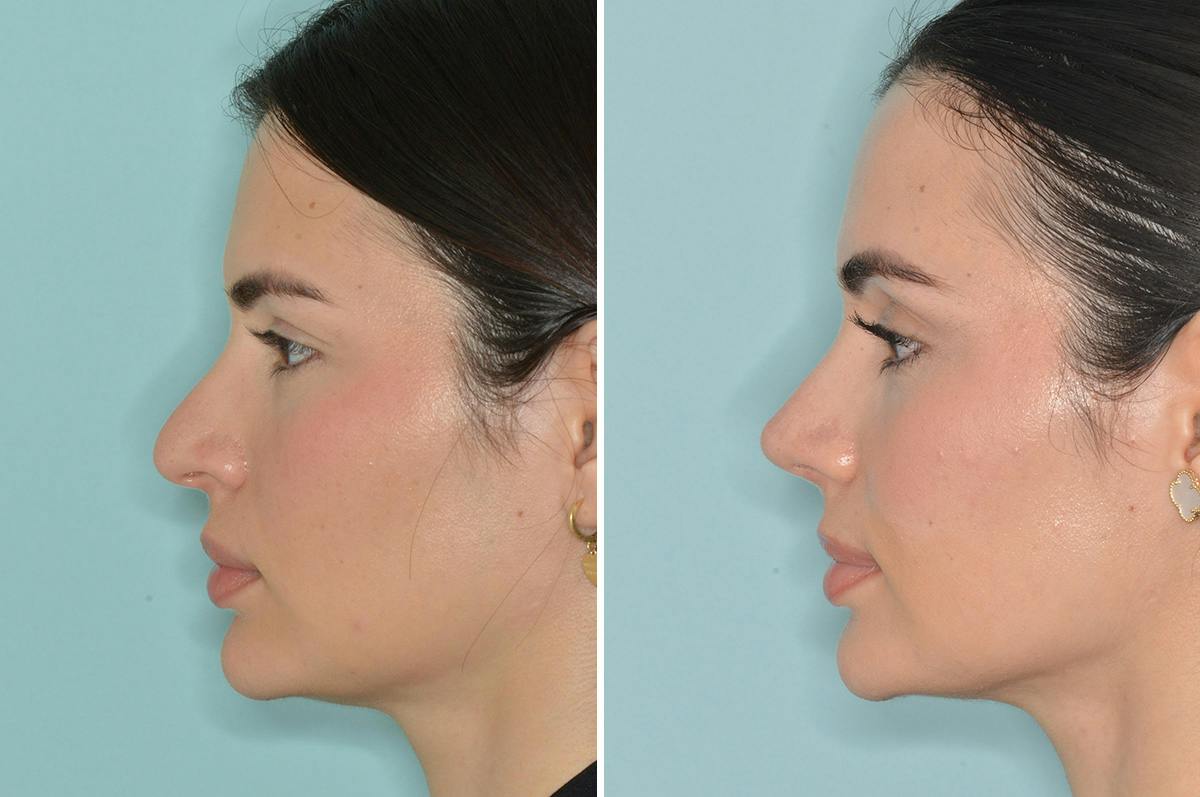 Rhinoplasty Before & After Gallery - Patient 124095 - Image 2