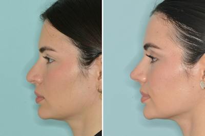 Rhinoplasty Before & After Gallery - Patient 124095 - Image 2