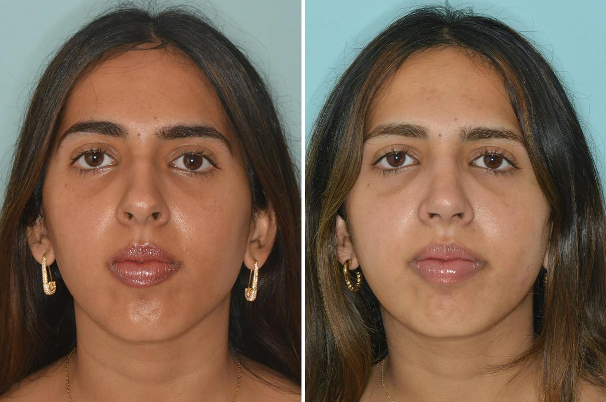Rhinoplasty Before & After Gallery - Patient 262337 - Image 3