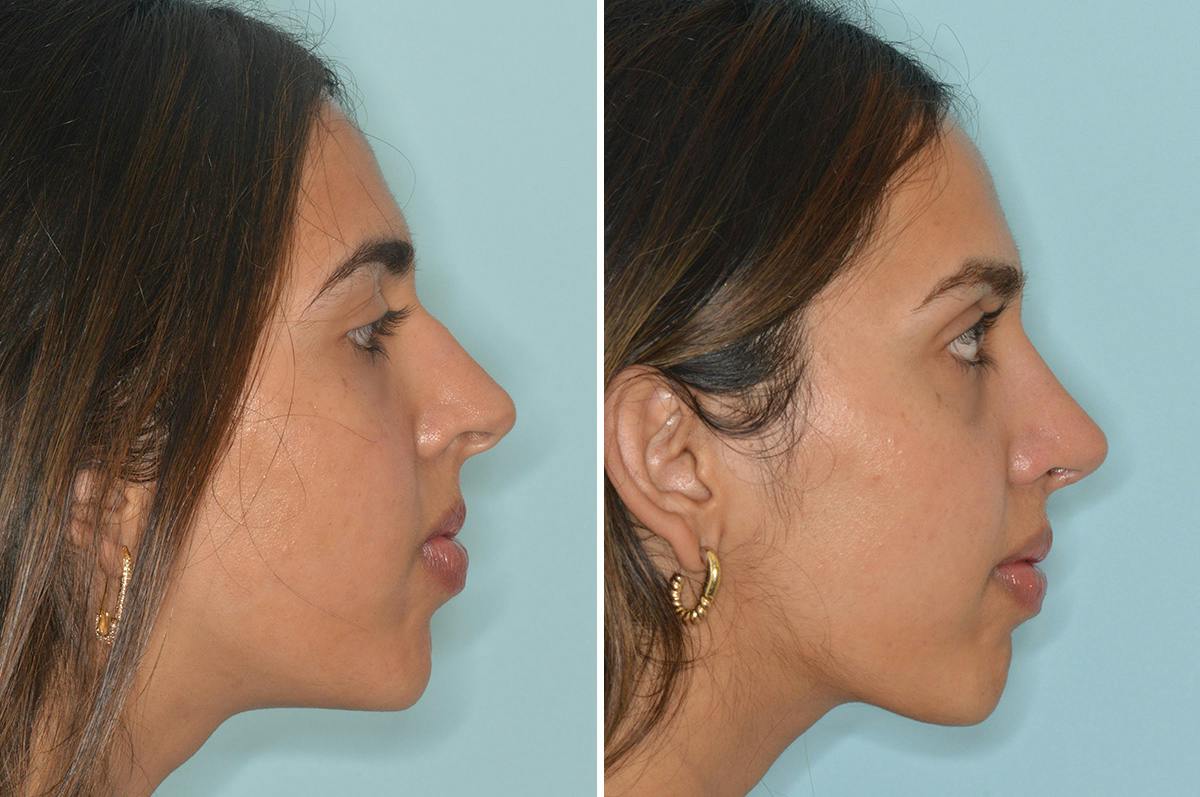 Rhinoplasty Before & After Gallery - Patient 262337 - Image 1