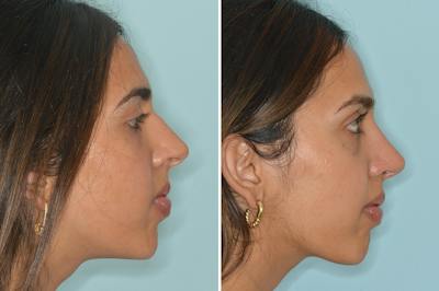 Rhinoplasty Before & After Gallery - Patient 262337 - Image 1