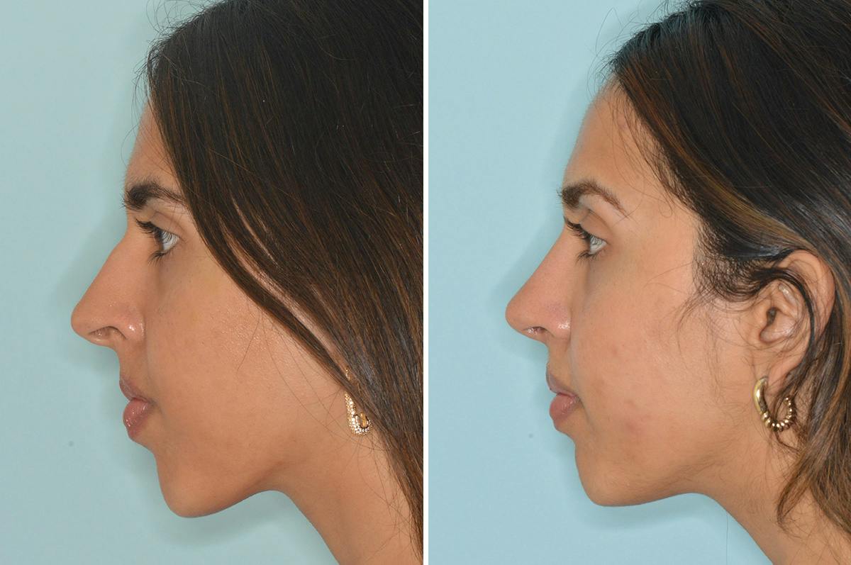 Rhinoplasty Before & After Gallery - Patient 262337 - Image 2