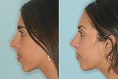 Rhinoplasty Before & After Gallery - Patient 262337 - Image 2