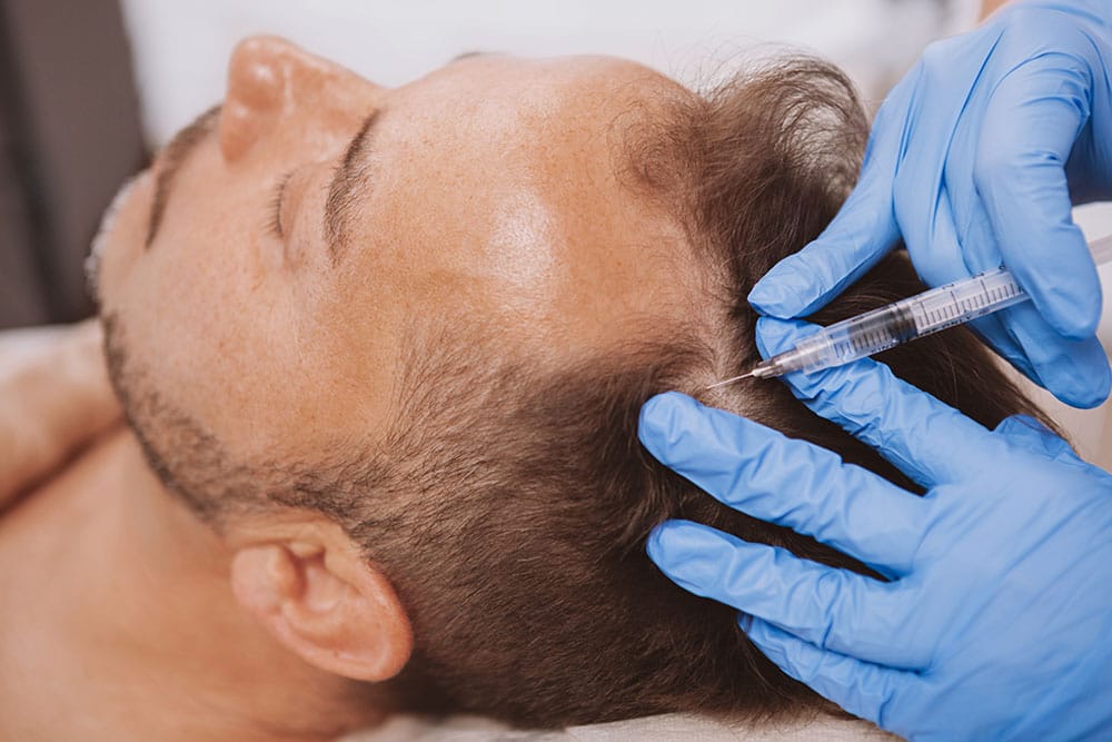 man getting prp after his hair trasplant in Miami, FL