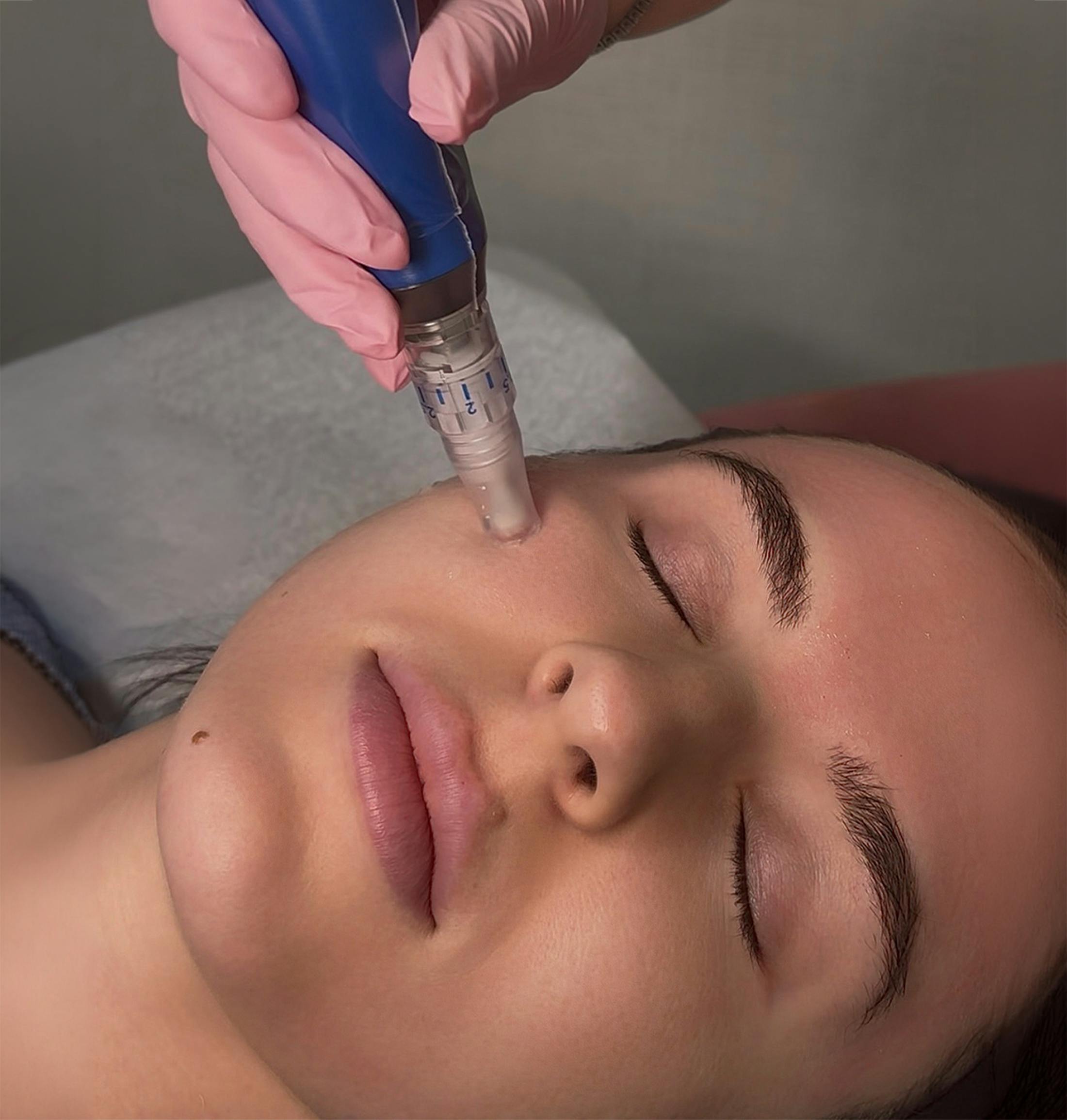 A patient getting microneedling done