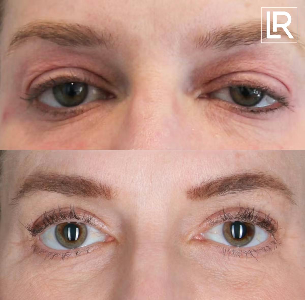 Eyelid Lift Before & After Gallery - Patient 101002 - Image 1