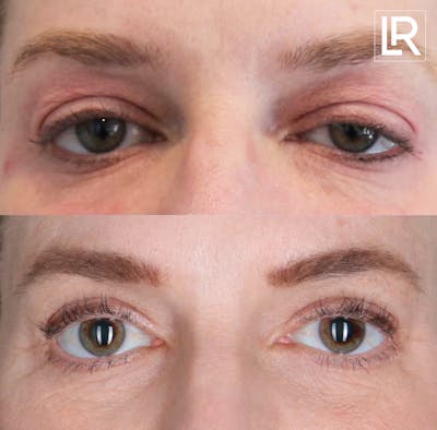 Eyelid Lift Before & After Gallery - Patient 101002 - Image 1