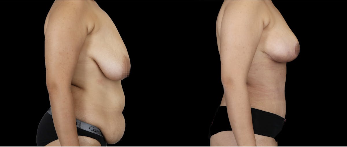 Body Transformation Before & After Gallery - Patient 817729 - Image 1