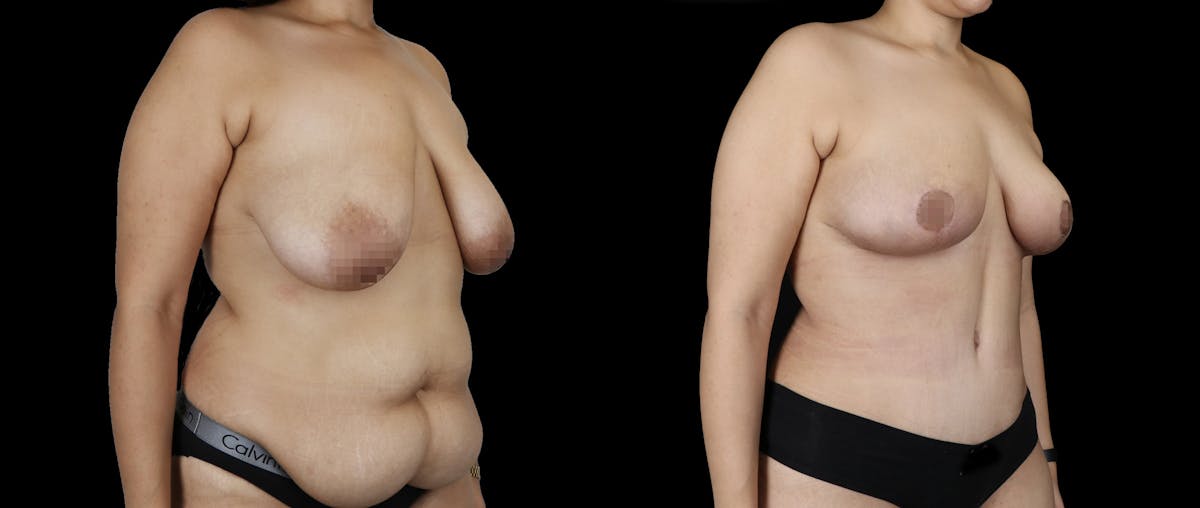 Body Transformation Before & After Gallery - Patient 817729 - Image 2