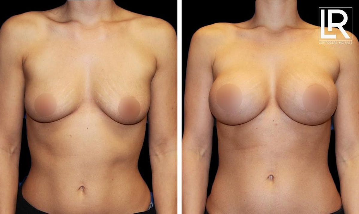 Breast Augmentation Before & After Gallery - Patient 298891 - Image 1
