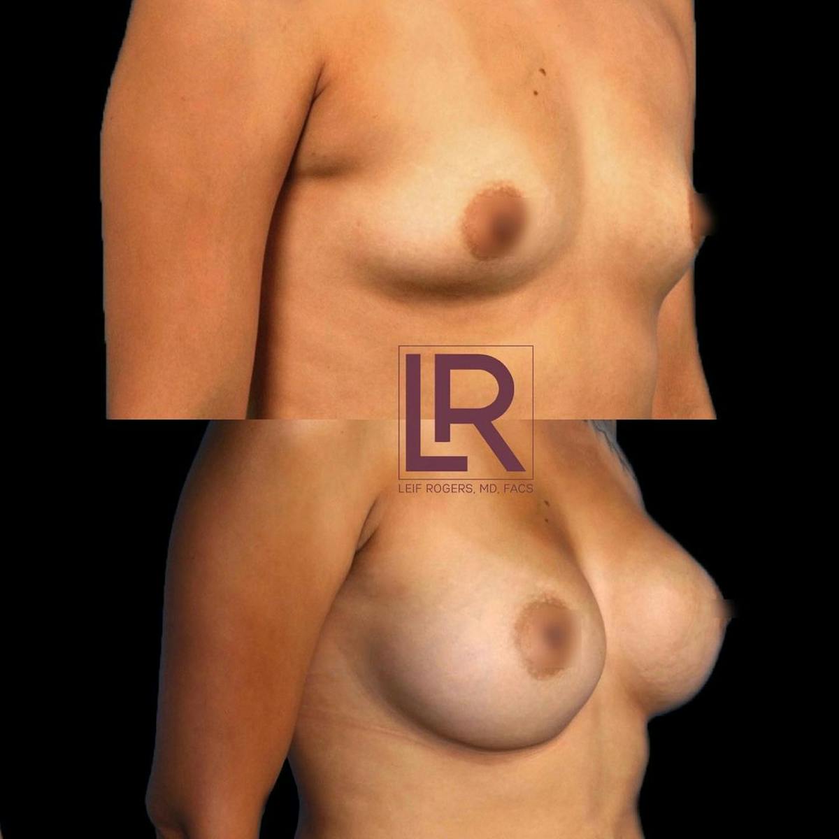 Breast Augmentation Before & After Gallery - Patient 427968 - Image 1