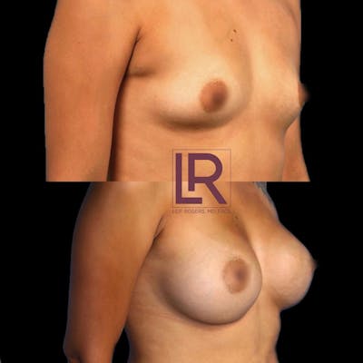 Breast Augmentation Before & After Gallery - Patient 427968 - Image 1