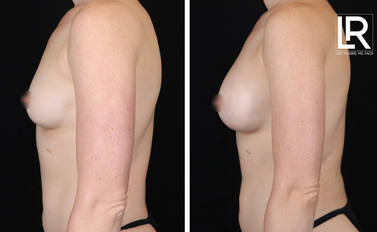 Breast Augmentation Before & After Gallery - Patient 298983 - Image 2